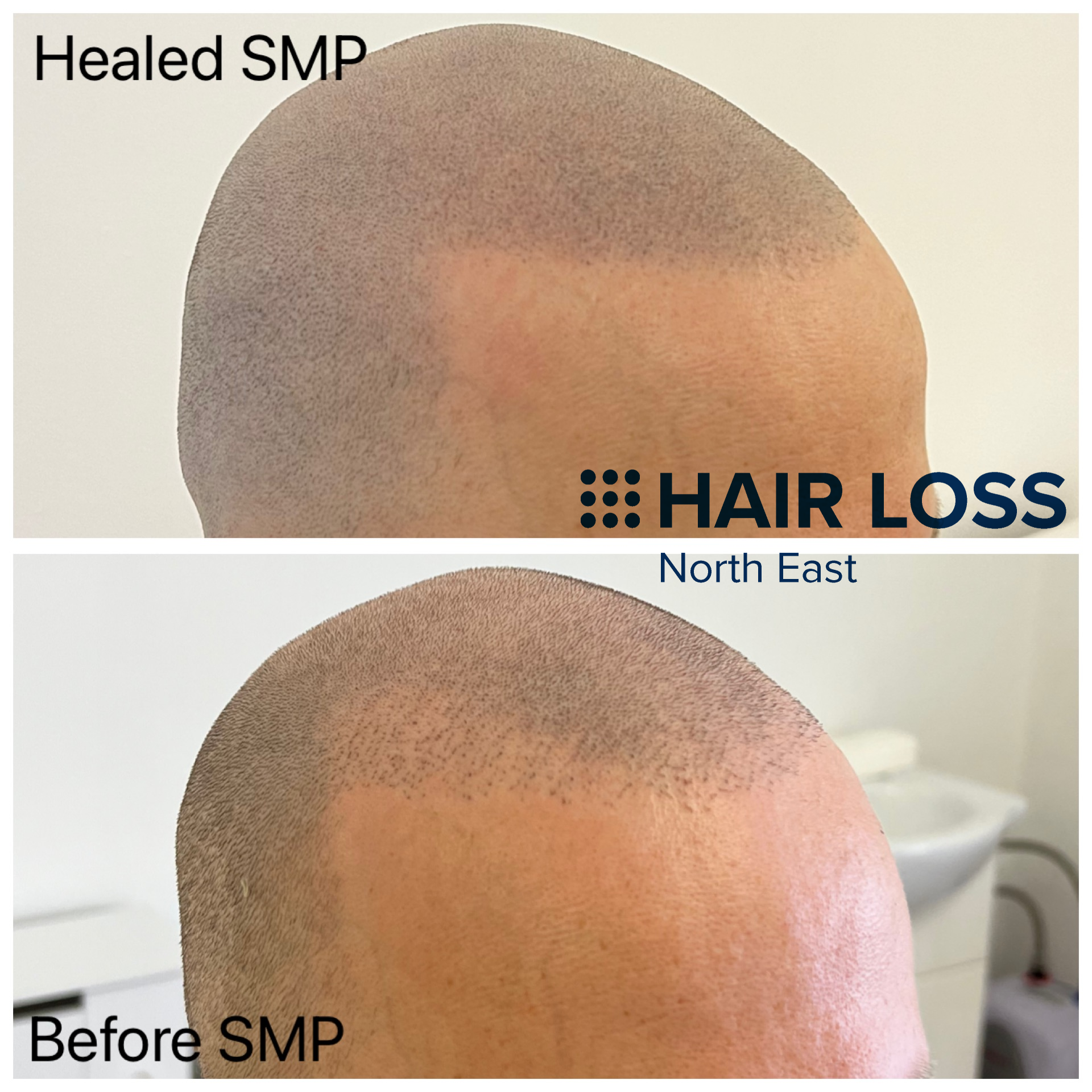 FUE Hair transplant Scalp Micro pigmentation